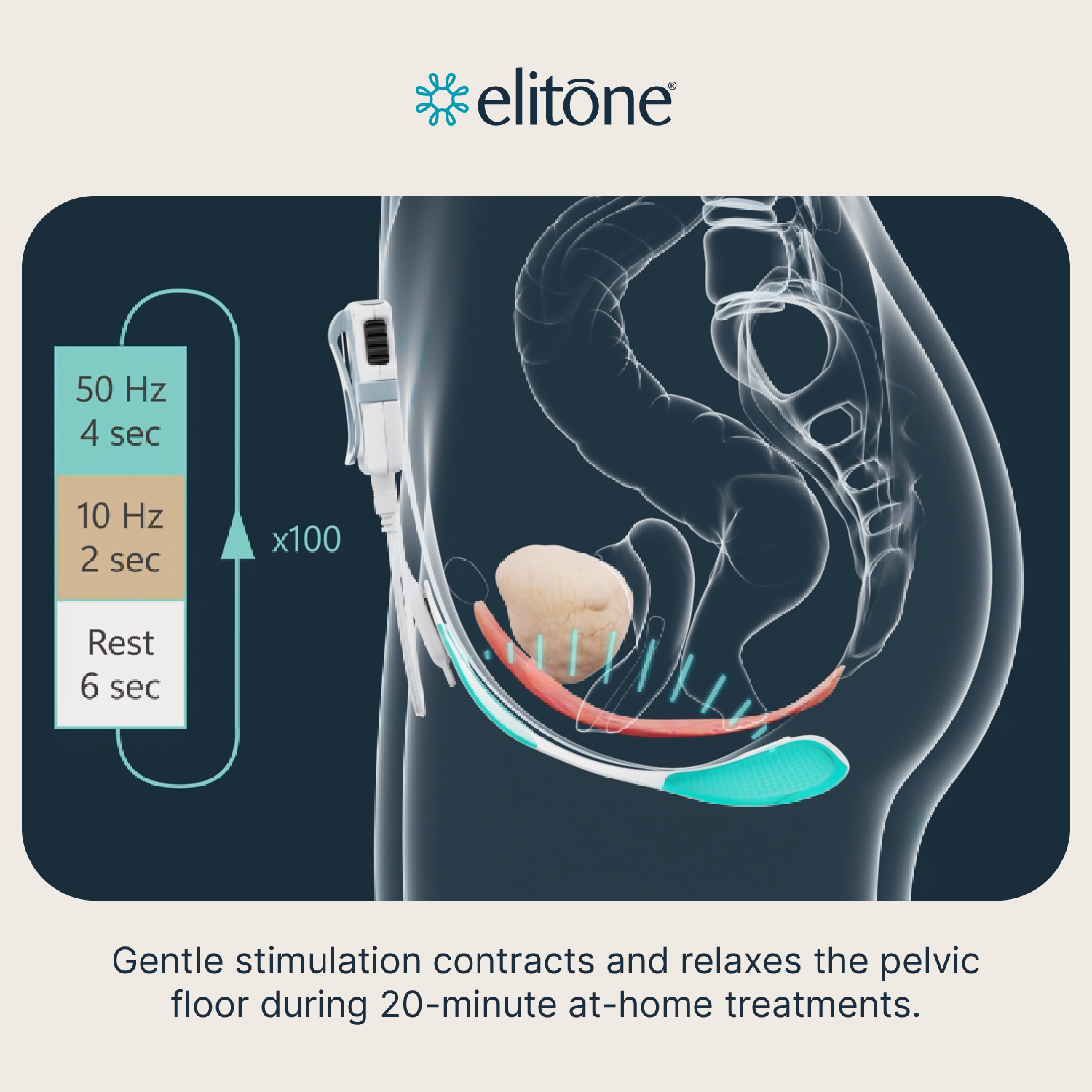 ELITONE Female Incontinence External Pelvic Floor Exerciser Therapy Kit